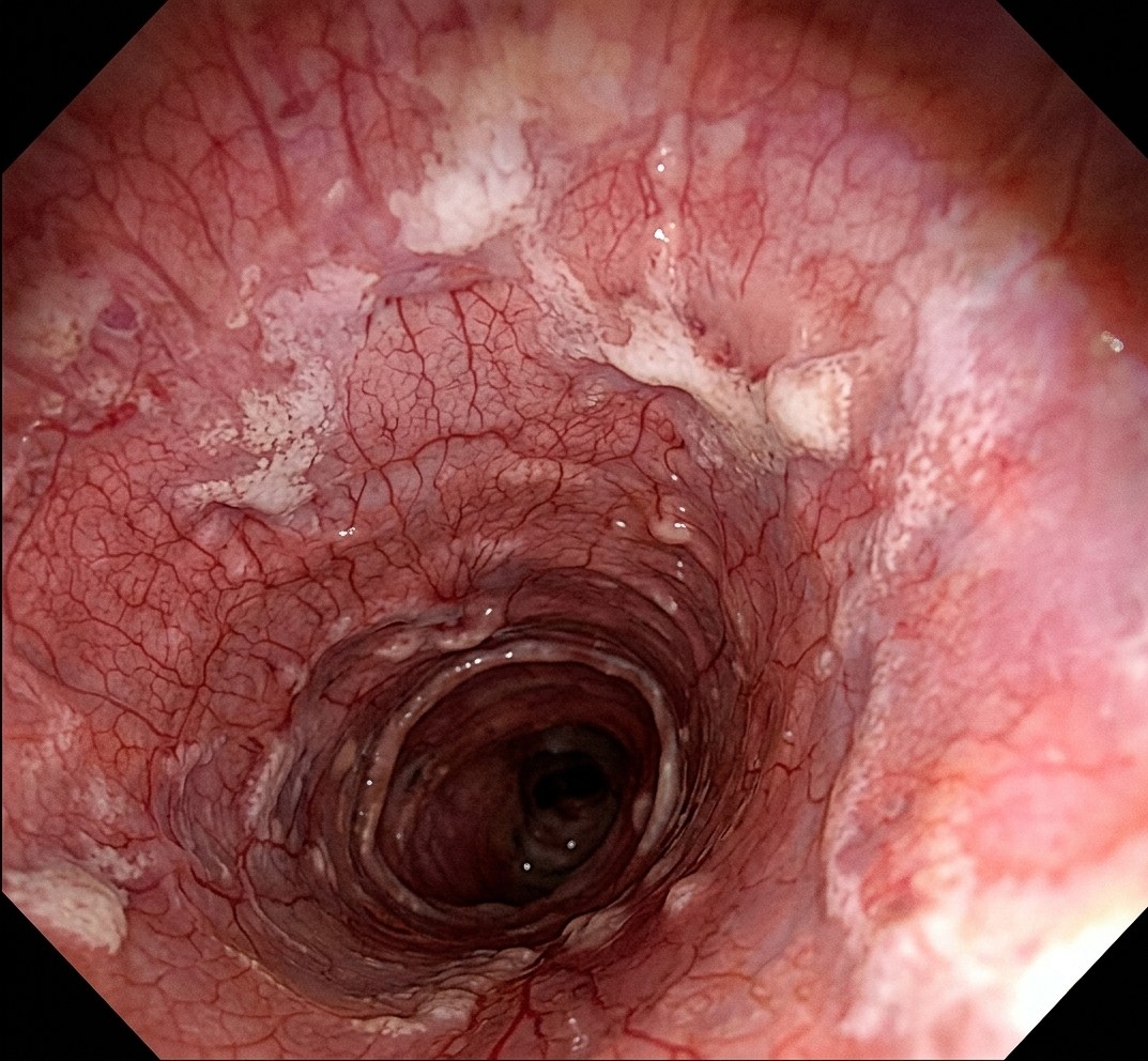 Endoscopiebeeld van de luchtwegen na vier behandelingen