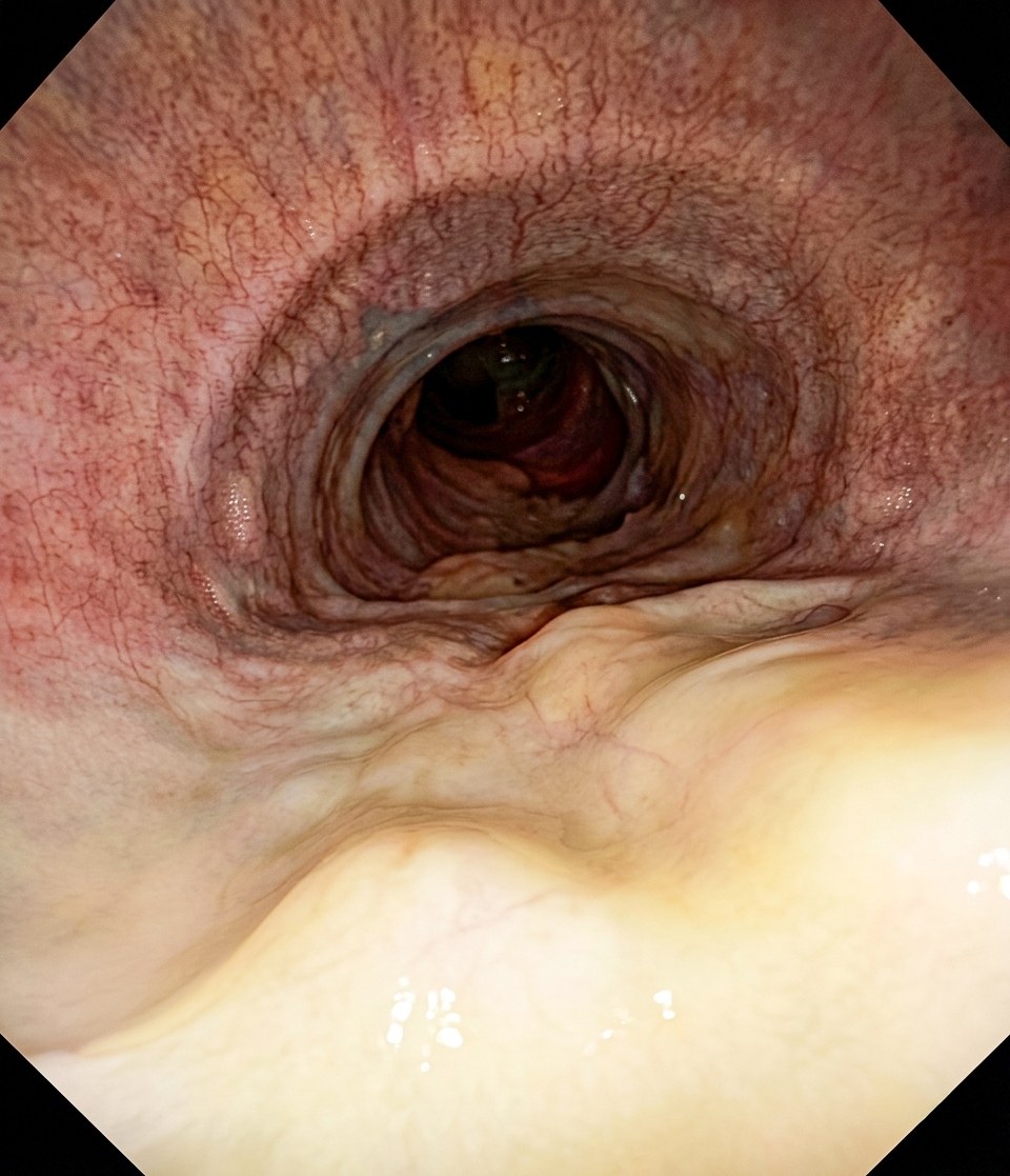 Endoscopiebeeld van de luchtwegen vóór de behandeling